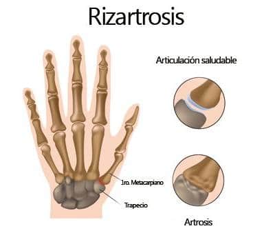 rizartrosis-artrosis-pulgar